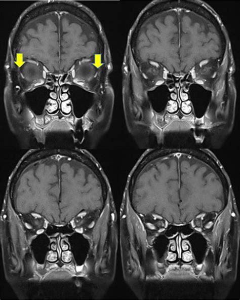 MRI - Sagging Eye - Box Hill Eye Surgeons