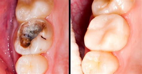 Reverse Cavities and Heal Tooth Decay With THESE 5 Steps! - DavidWolfe.com