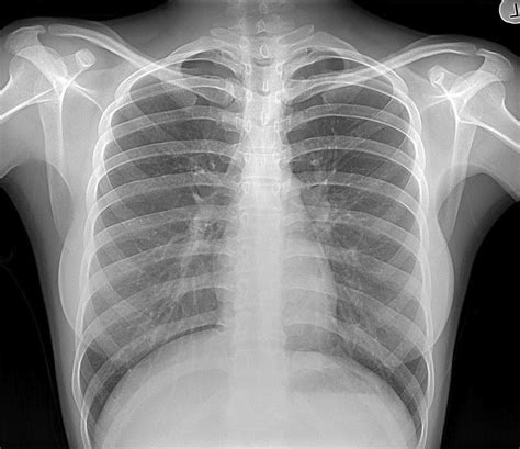 Normal Chest X-ray | AnatomyBox