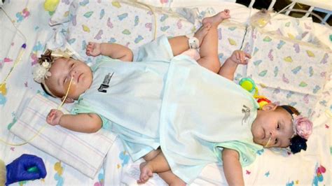 Texas Conjoined Sisters Successfully Separated Video - ABC News