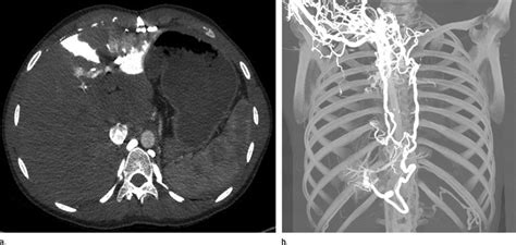 Images in a 42-year-old man with complete obstruction of the superior... | Download Scientific ...