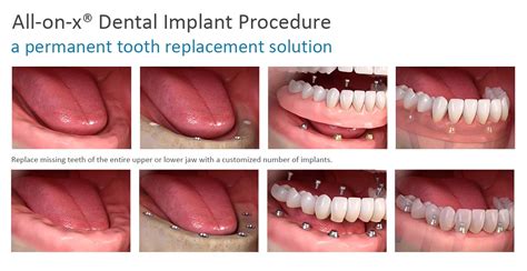 All-On-X NYC | All-On-X Dental Implants