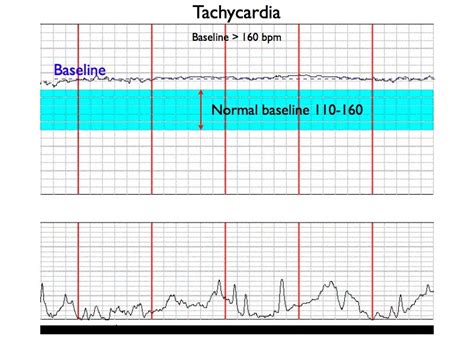 Basic Pattern Recognition – Electronic Fetal Monitoring