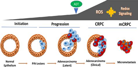 Oxidative stress and redox signaling in CRPC progression: therapeutic potential of clinically ...