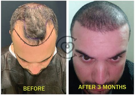 Hair Transplant | Cayra Clinic