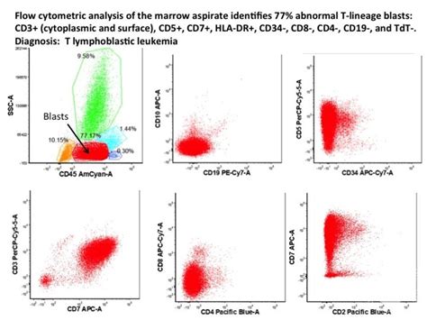 T cell ALL Flow Cytometry