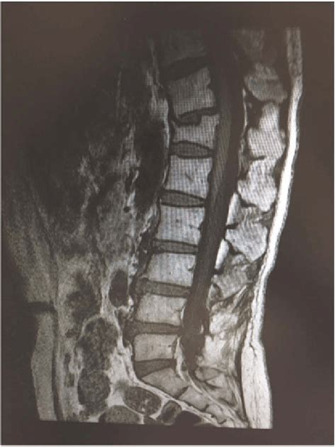 Mri Lumbar Spine Cancer