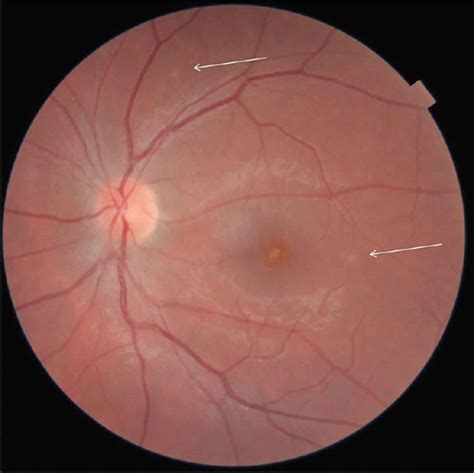 Multiple evanescent white dot syndrome causes, symptoms, diagnosis, treatment & prognosis