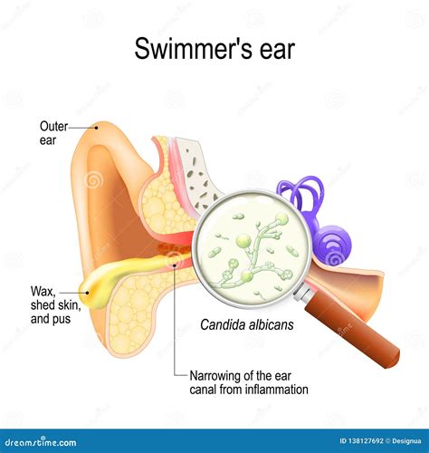 Fungal Infection On Scalp Vector Illustration | CartoonDealer.com ...