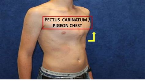 Pigeon chest / Pectus Carinatum