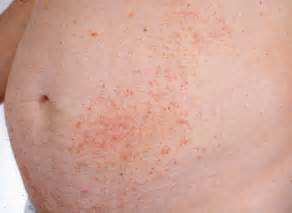 Dermatitis herpetiforme - Wikiwand