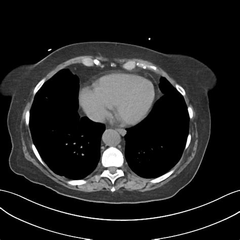 Cholangitis CT - wikidoc