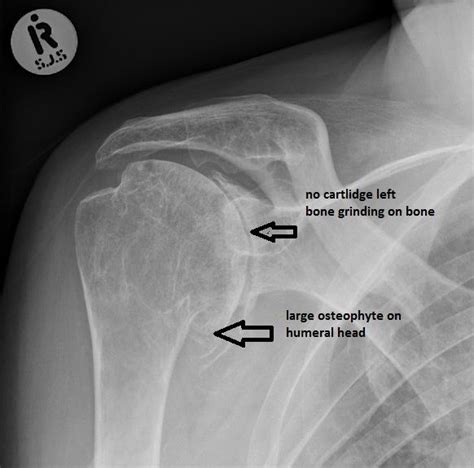 Causas de la osteoartritis del hombro, síntomas, tratamientos | 2022