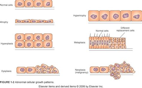 neoplasia metaplasia dysplasia - Google Search | Dibujos de doctoras ...