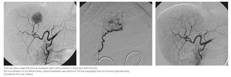 Endovascular procedures in HCC treatment | Blog