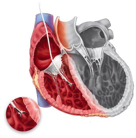 Endomyocardial Biopsy - Myocarditis Foundation