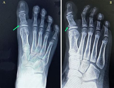 Type 2 Salter-Harris Physeal Injury of the Proximal Phalanx of Great ...