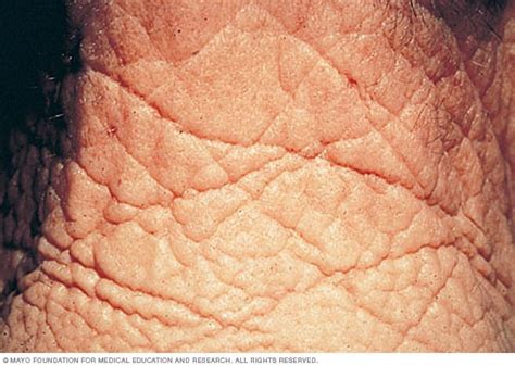 Wrinkles - Symptoms and causes - Mayo Clinic