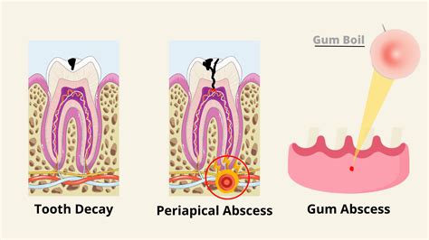 The stages of a gum abscess and its healing process