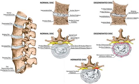 Spine and intervertebral disc anatomy in sagittal and cross-sectional ...