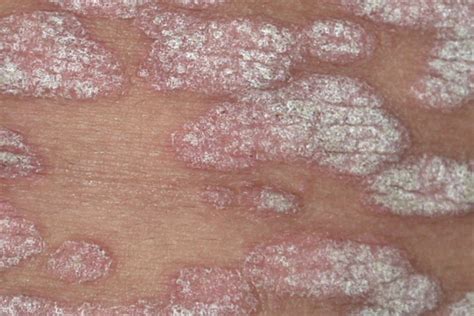 Topical Management of Recalcitrant Psoriasis & Eczema