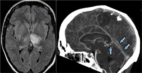 Cavernous Sinus Thrombosis Mrv