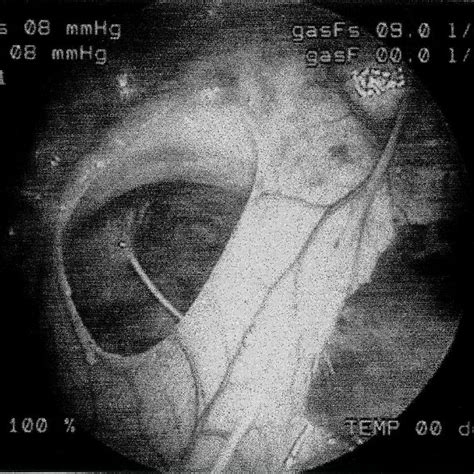 After creation of pericardial window, pericardioscopy was performed ...