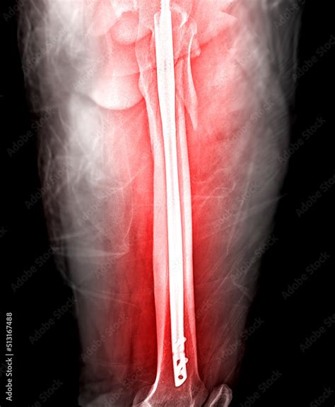 X-ray femur bone Fracture After Total Hip and femur Replacement. Stock Photo | Adobe Stock