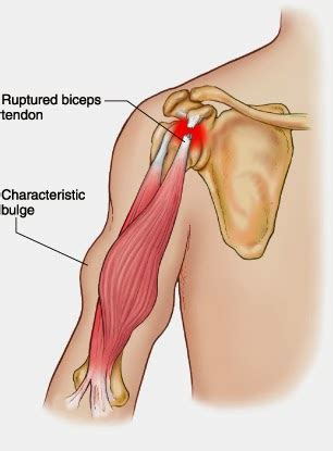 The Amazing Bodybuilding: Biceps Tendon Rupture and Advances in Surgical Treatment