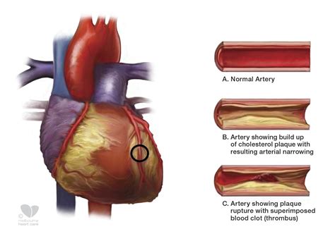 Atherosclerosis - Melbourne Heart Care