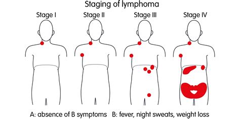 Childhood Hodgkin Lymphoma Disease – Stages and Prognosis