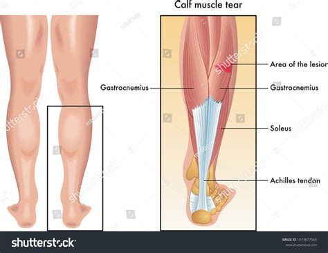 Medical Illustration Symptoms Calf Muscle Tear Stock Vector (Royalty Free) 1973677565 | Shutterstock