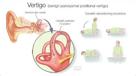 Mayo Clinic Q and A: Dizziness Caused by Inner Ear Crystals - Mayo Clinic News Network