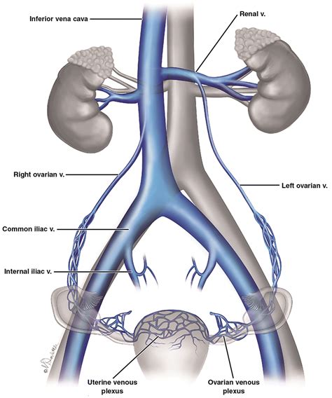 Pelvic Congestion Syndrome - Commonwealth Interventional Radiology