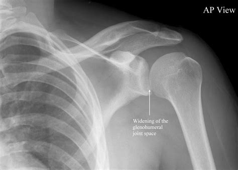 shoulder dislocation,WHAT TO KNOW?