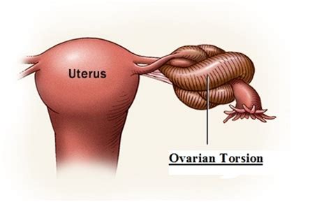 A Case of Adnexial Torsion During Pregnancy: Shortcomings in Doppler Ultrasonography ...