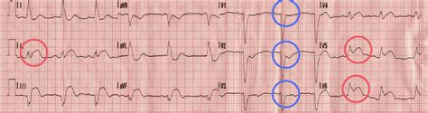 Sgarbossa Criteria | Nucleotype