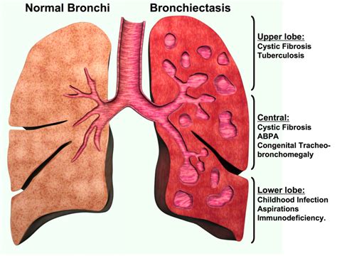 Bronchiectasis Herbal Cure Treatment - Herbs Solutions By Nature