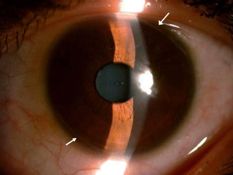 Effect of Limbal relaxing incisions during implantable collamer lens ...