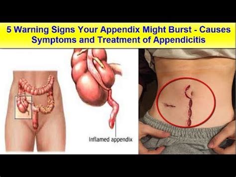 5 Warning Signs Your Appendix Might Burst - Causes Symptoms and ...