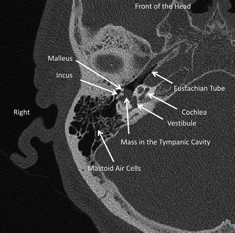 Axial (horizontal) CT of the right temporal bone at the level of the ...