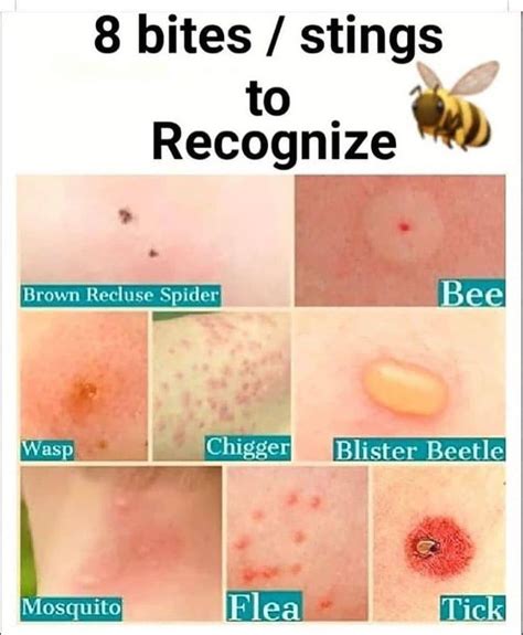 different types of mosquito bites and stings to recognize with the caption below