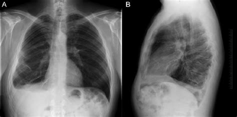 Pleural Effusion X Ray Lateral