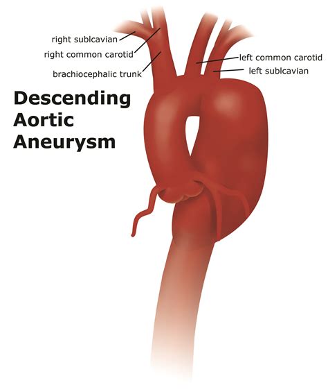 Thoracic Aortic: Fusiform Thoracic Aortic Aneurysm