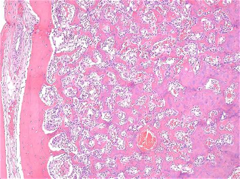 Osteoid Osteoma Histology