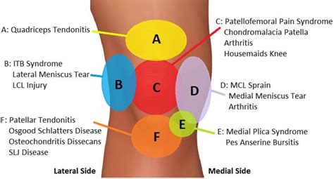 Pin on Common Causes of Knee Pain