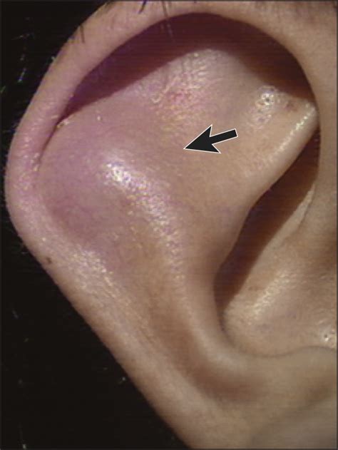 ENT: Tumors of external ear | notes.nursium.com