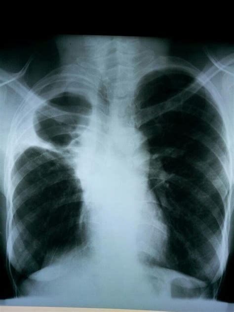 Loculated Pleural Effusion - Pdf Intrapleural Streptokinase For ...