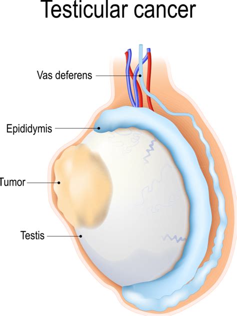 Testicular Cancer Chattanooga - UT Erlanger Urology