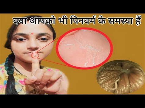 सिर्फ 1 रात मे Pinworms होगा खत्म | How to get rid of Pinworms | Threadworms treatment at home ...